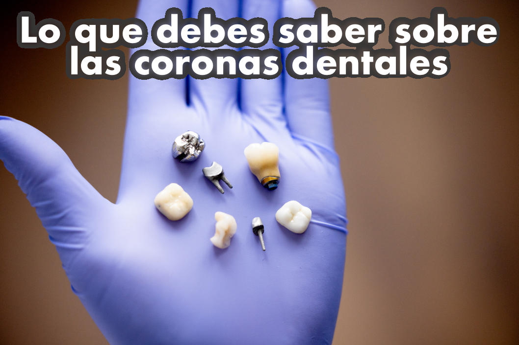 Lo que debes saber de  las coronas Dentales 